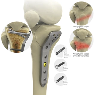 Zimed Proximal Medial Tibial Plate Small